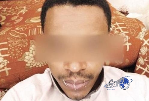 مواطن بجازان يخيّط فمه لعدم صرفه “إعانة النزوح” أسوة برفاقه