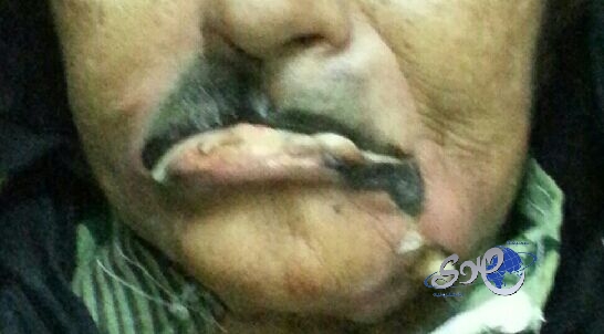 وفاة مسنة بسبب إهمال طبيب أسنان بمستشفى فرسان بجازان