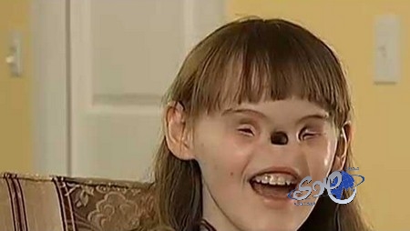 بالفيديو: فتاة أميركية بدون أنف وعينين حيرت العالم
