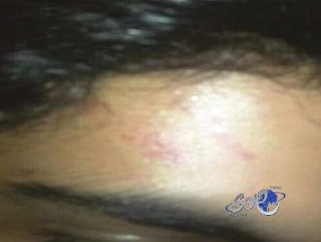 معلم عربي يتسبب في «كدمات» لطالب «مدرسة أهلية» .. و«التربية» تحقق