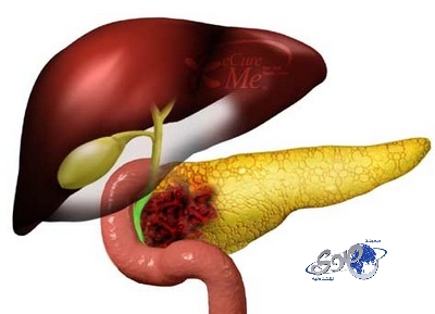 أمل جديد لعلاج سرطان البنكرياس باستخدام جراثيم مشعة