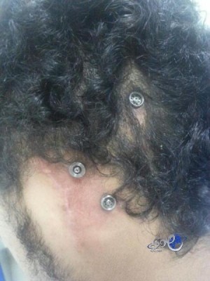 زراعة “معدات السمع العظمية” بمدينة الملك سعود بالرياض