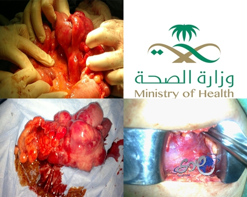 استأصال ورم فطري نادر وكبير جداً يسمى “يلازيدر يوليو ميكوزيس”