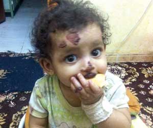 “نقل دم” يحلل جلد “الجوري” والمستشفى: “مرض وراثي”