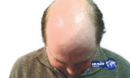 الصلع كابوس يؤرق الرجال