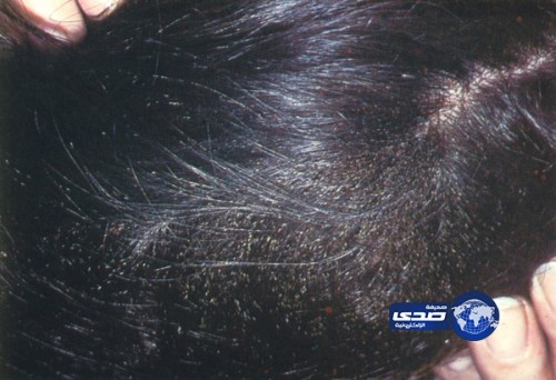 القمل يهاجم ابتدائية البنات في بيشة ويصيب 40 طالبة