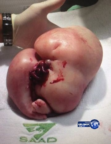 ولادة نادرة لتوأم أحدهما كتلة جنينية بلا قلب ومبهمة الخلقة