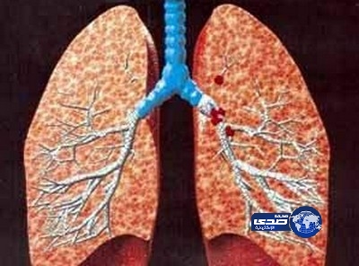 علاج جديد لمرضى سرطان الرئة
