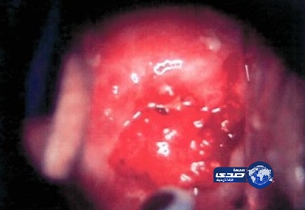 فحص بسيط غير مكلف يكشف عن سرطان عنق الرحم