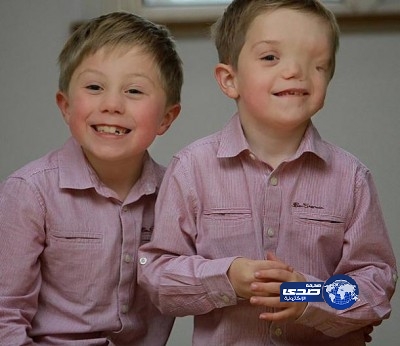 في حالة غريبة من نوعها .. طفل بنصف وجه ” شاهد الصور”