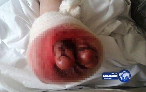 إستيقظ من النوم فيجد كلبه التهم أصابع قدميه!