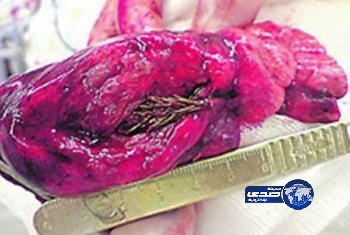 ابتلع بذرة.. فنبتت في رئته !