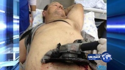 بالقدرة الألهية ينجو من الموت بعد اختراق منشار لبطنه