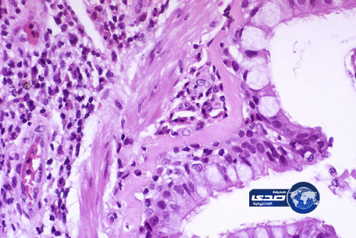 “أبو سبعة” مرضى الربو الشعبي والمزمن يستطيعون غالباً الصوم