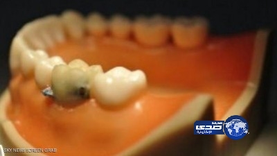 أسنان ذكية تراقب طعامك وشرابك