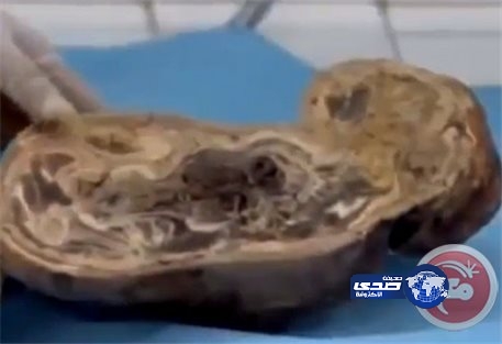 أطول حمل في التاريخ لسيدة مغربية استمر 48 عاماً