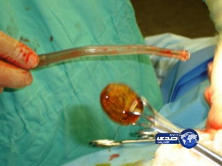 تبيع حصى مرارتها في مزاد .. بداعي الدعابه