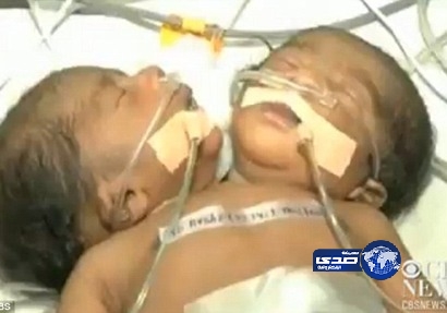 بالصور: ولادة طفل برأسين في الهند !