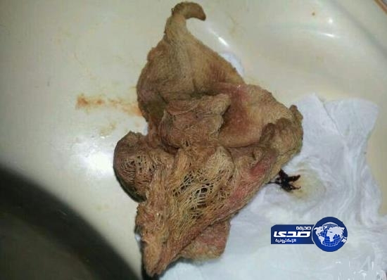 “صورة” آلام مبرحة تكشف نسيان “شاش” طوله متر برحم سيدة