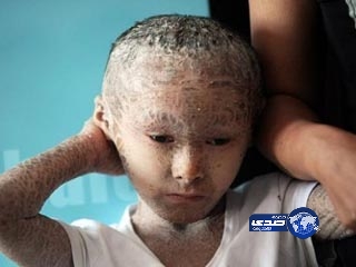 مرض يحول طفلا إلى سمكة