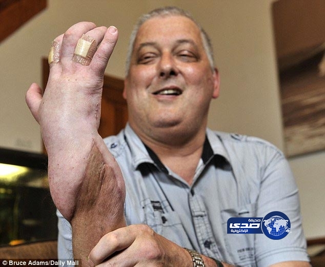 بالصور.. زرع أول يد في بريطانيا