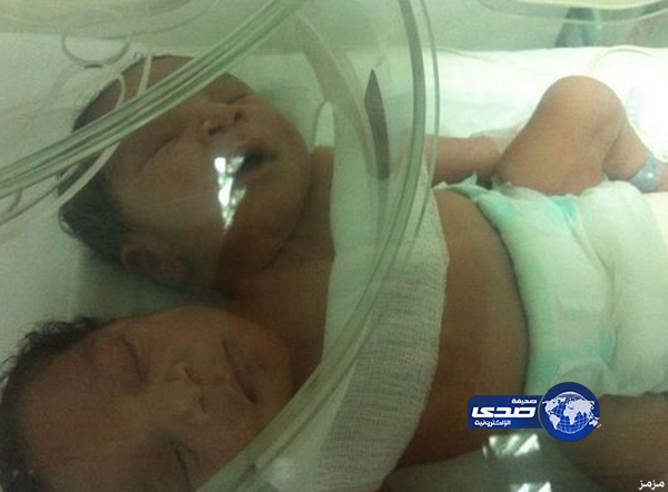 وفاة الطفلين السياميين السعوديين” عبدالله” و” عبدالرحمن” عصر هذا اليوم