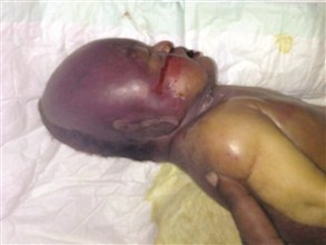 خطأ طبي يودي بحياة رضيع سحبت عينه من نخاعه الشوكي بجازان