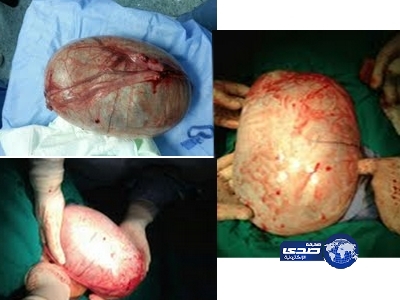 استئصال ورم وزنه 15 كجم من بطن فتاة بمستشفى الخميس