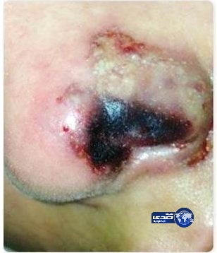 هروب “دكتور” تجميل مشهور بعد تشويه أنف خليجية