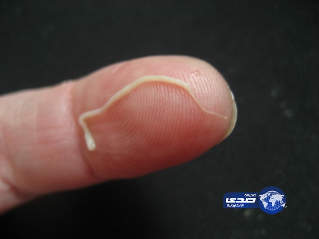 بعد فشلها في “الرجيم” تبتلع دودة شريطية لإنقاص وزنها