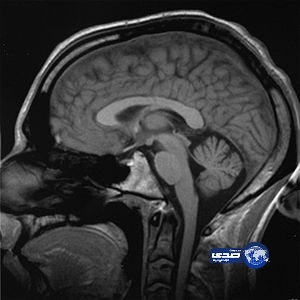 دماغ المصابات بالتوحّد يشبه دماغ الشبّان غير المصابين