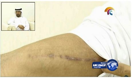 بالفيديو: شاب إماراتي يحقن نفسه بالسيلكون للحصول على جسد مثالي