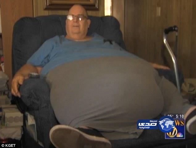 استئصال ورم يزن 90 كيلوجراماً من بطن ستيني بعد أن عاش به 14 عاماً