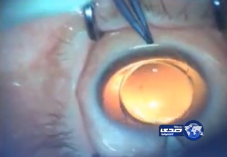 “تلوين العينين” آخر صيحات عمليات التجميل