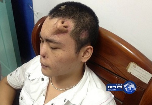 بالصور..زراعة أنف فوق الحاجب