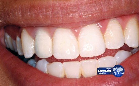 ضرس ذكي يراقب مضغ الطعام