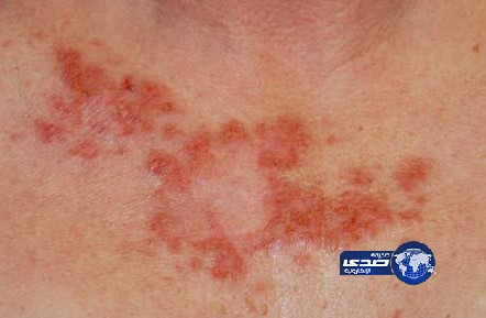 علاج جهاز المناعة يعطي الأمل لشفاء اكلينيكي لسرطان الجلد