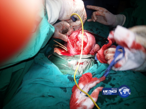 جراحة ناجحة تنهي معاناة فتاة مع ورم ليفي ضخم في الرحم