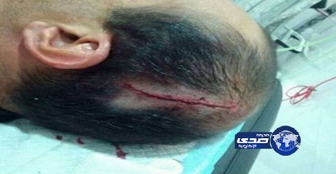 شج رأس أبن اخ الرئيس اليمني السابق