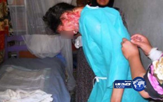 شاب يضرم النار في زوجته بعد خلاف على عائدات بيع أضاحي العيد