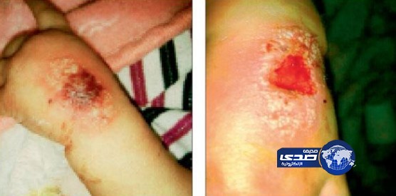 مواطن يتهم كادرا تمريضيا بالتسبب في «عفونة» يد طفلته