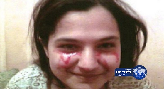 فتاة جزائرية تنزف دما من عينيها وأذنيها