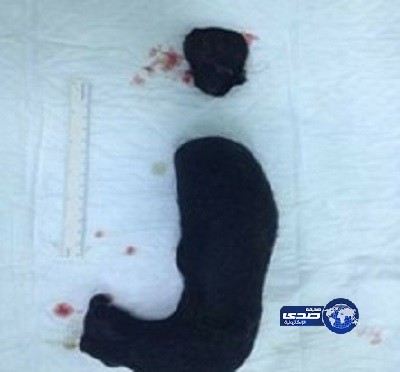 استخراج كتلة شعرية من بطن فتاة بعرعر