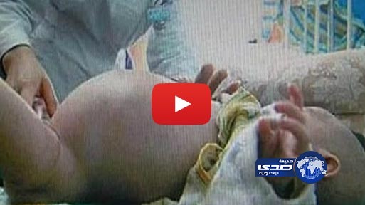 بالفيديو..  إخراج توأم من بطن طفل صيني!