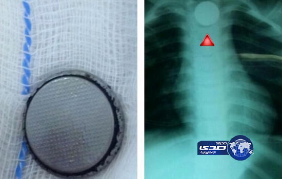 استخراج “بطارية” من مريء طفل عمره 4 سنوات بالمدينة