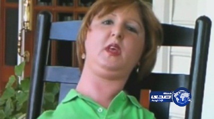 مرض نادر يحول أمريكية إلى تمثال