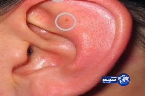 معالجة شعبية عذرية الرجال تكشف من أُذنانهم !