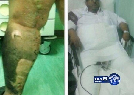 كيبل اهملته شركة الكهرباء ينفجر في سعودي وابنه بالرياض (صور)