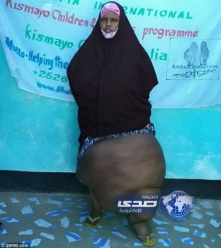 بالصور والفيديو : &#8220;روح شريرة&#8221; تسكن امرأة صومالية تحول ساقها كالفيل !!