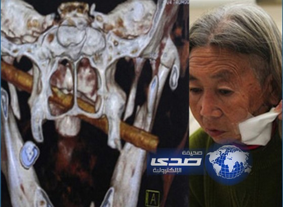 تعيش وفي رأسها عصا دون علمها